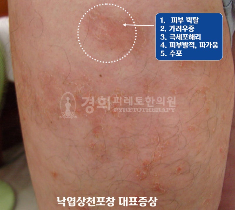 낙엽상천포창 case study - 증상이 병인 잡는 열쇠다!!