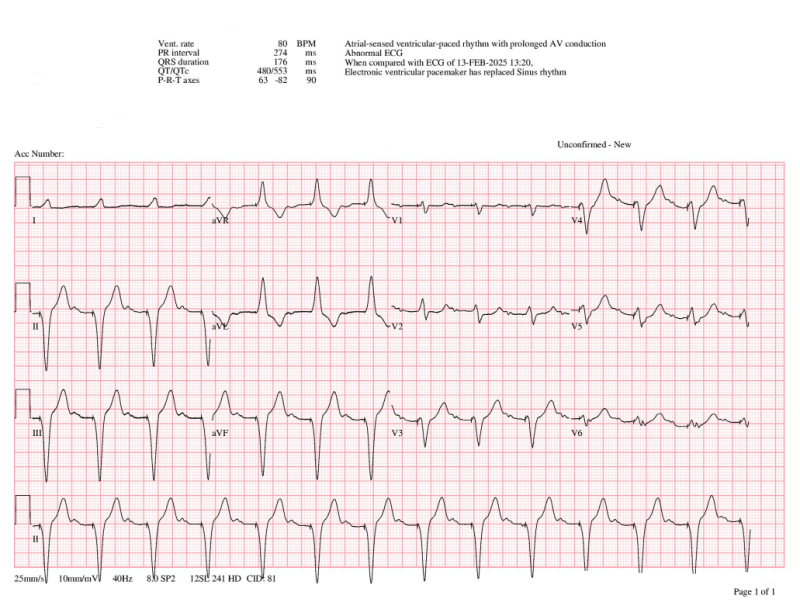 M) STEMI Mimics - Ventricular paced rhythm : 네이버 블로그