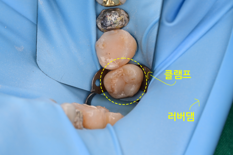  인레이 치료한지 오래되어서 이차 충치 생긴 치아, 레진빌드업으로 치료하기
