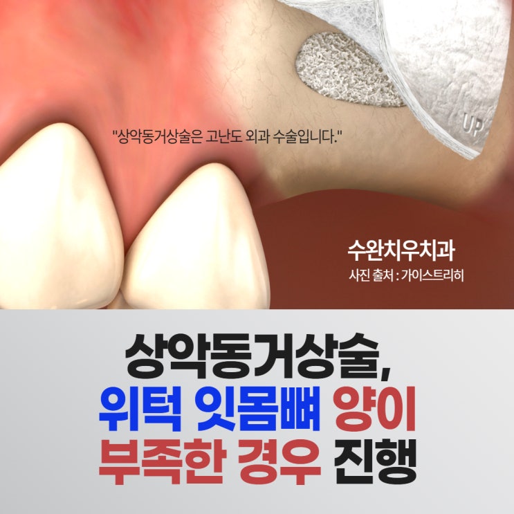  상악동거상술, 위턱 잇몸뼈 양이 부족한 경우에 진행
