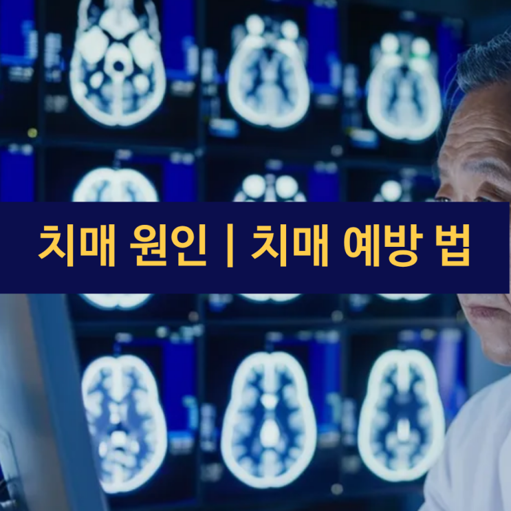  치매란? 치매 원인 | 치매 예방 법 | 음식, 생활습관, 영양제 | 치매 최신 연구 동향