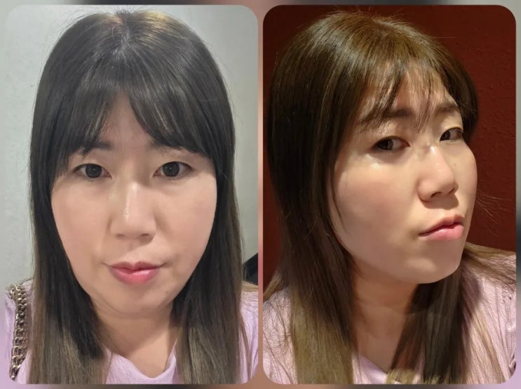  [부산연산동피부과]브이라인 위해 선택한 브이로 리프팅 후기