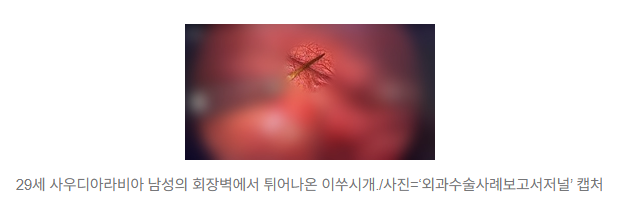   이쑤시개 삼켜 장에 구멍까지…사우디 29세 남성의 충격 사고