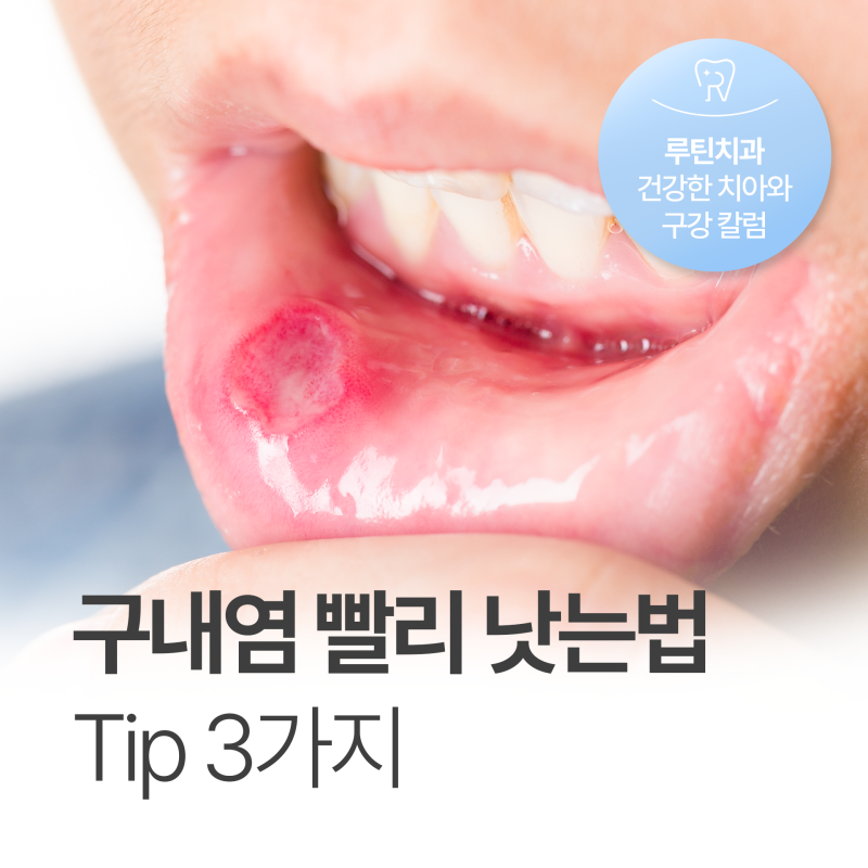목 구내염 빨리 낫는법 팁 3가지