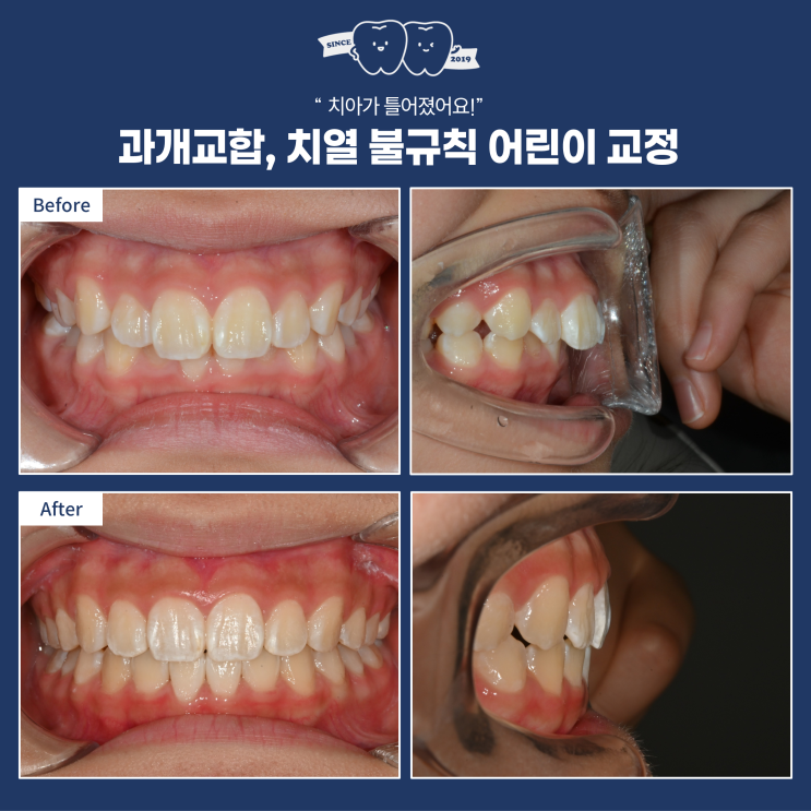  인비절라인 퍼스트의 장점, 이젠 헤드기어 없이 투명교정으로! 턱 교정까지!(feat. 빠르고 쉬운 교정의 완성)