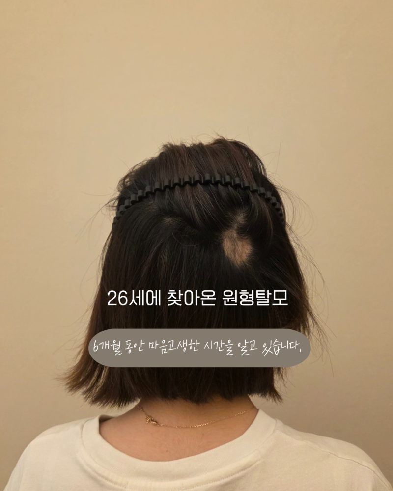 울산원형탈모 치료후기