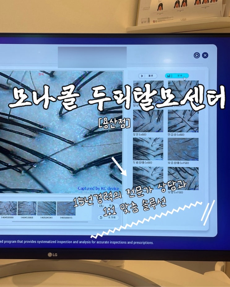  신용산탈모관리 모나클 두피탈모센터 용산점 추천하는이유