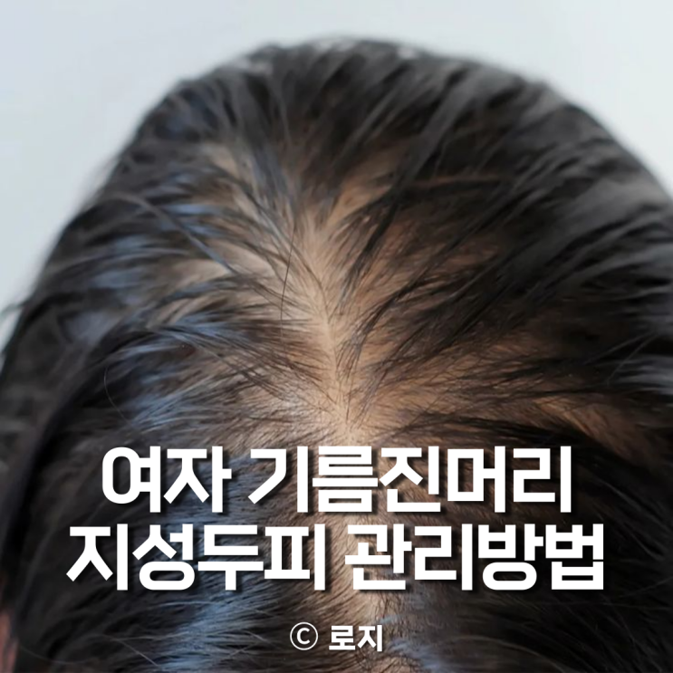  여자 머리 떡짐 기름짐 해결법 지성두피 관리 꿀팁 총정리