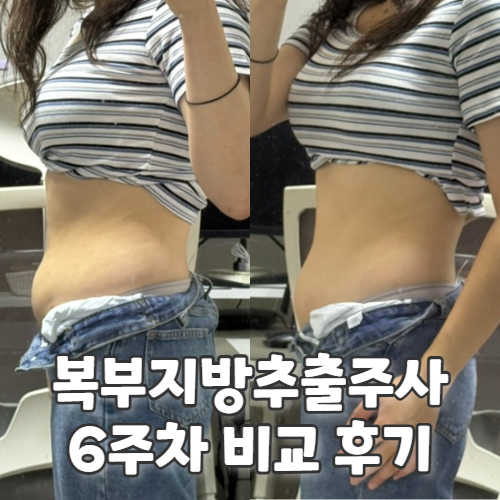  강남 지방추출주사 복부 효과, 6주차 부작용 붓기 후기