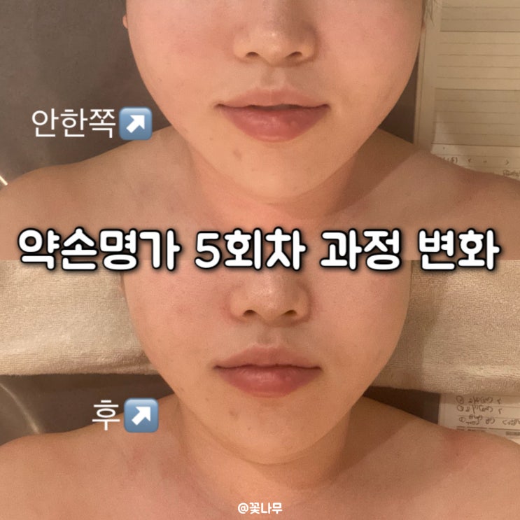  약손명가 맞춤관리 얼굴라인 턱선 효과 5회차 변화 과정