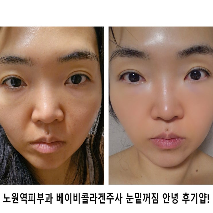  노원역피부과 베이비콜라겐주사 눈밑꺼짐 안녕 후기얍!