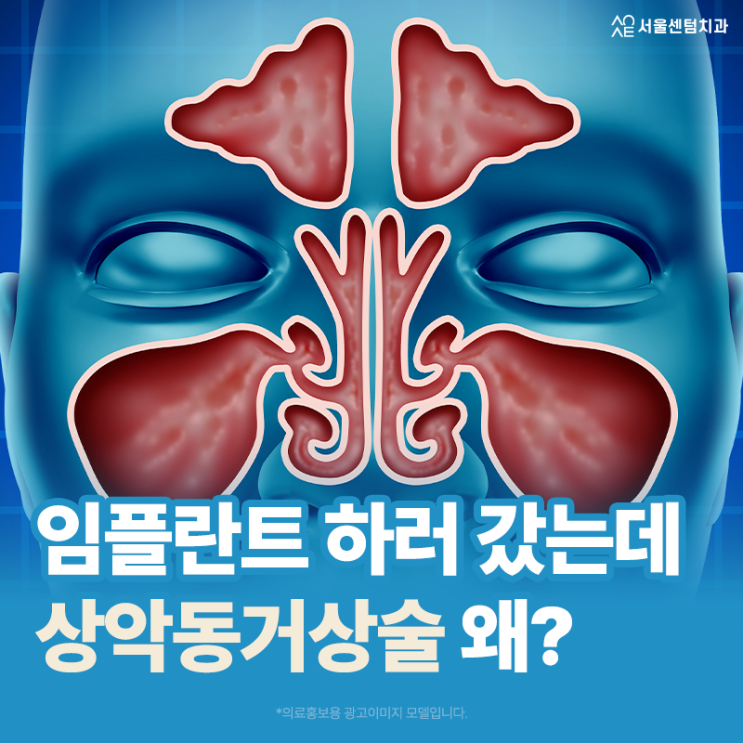  상악동거상술 통증 갑자기 임플란트 하러 치과갔는데 추가로 왜 해야할까요?