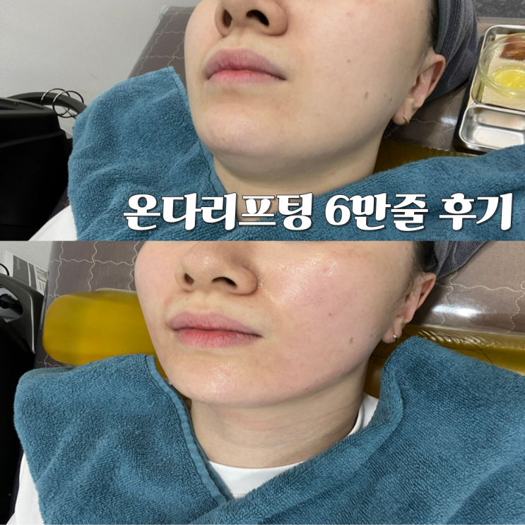  의정부피부과 온다 리프팅 6만줄 후기