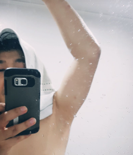  겨드랑이 냄새 제거 액취증 원인 미라드라이 수술 비용