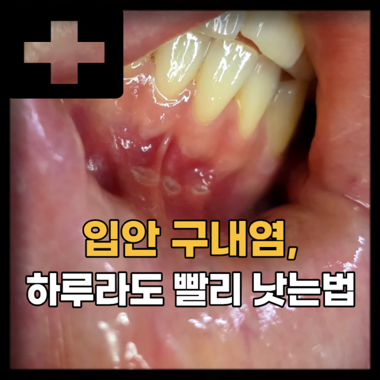  구내염 원인, 잇몸 구내염 빨리 낫는법