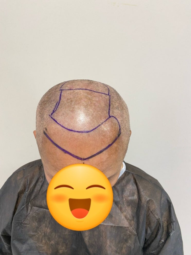  터키 비절개 모발이식 모수별 대략적인 영역 가늠하기
