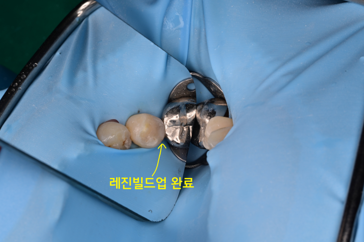  충치치료, 인레이가 더 단단할까? 레진이 더 단단할까? 우리 치과가 레진으로 주로 치료하는 이유