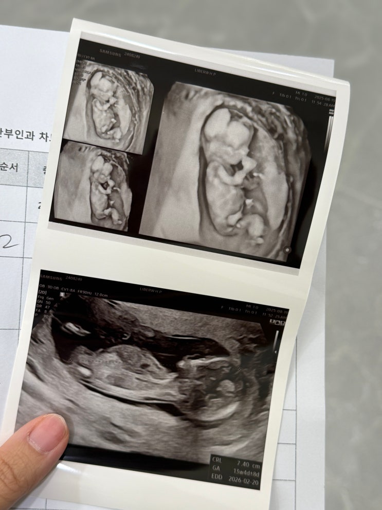  임신 12주차 초음파 1차 기형아검사 & 성별 각도법, 일상까지!