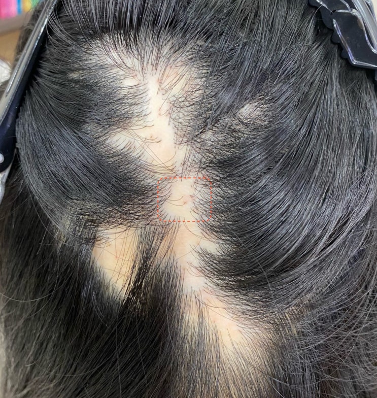  중증 원형탈모 완치과정에 중요한 것은? (홍대 발머스 한의원 실제 사례로 알아보는 난치성 면역질환의 특수성)