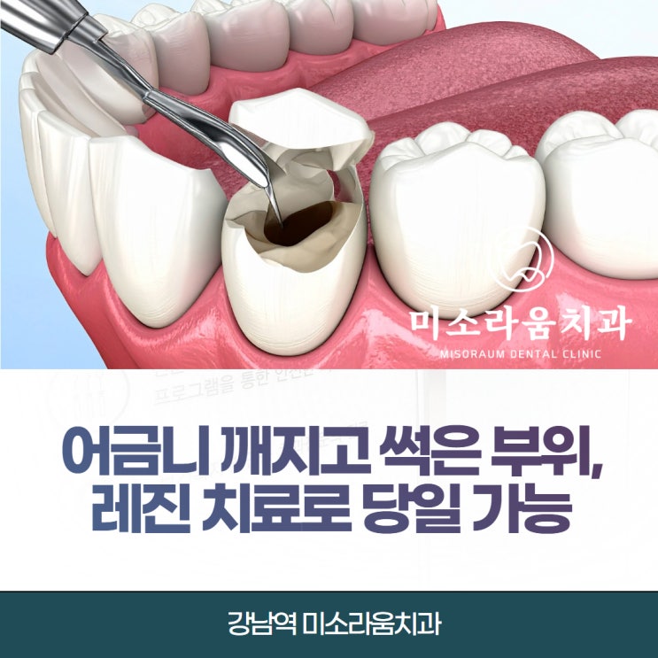  어금니 깨지고 썩은 부위 레진 치료로 당일 가능할까