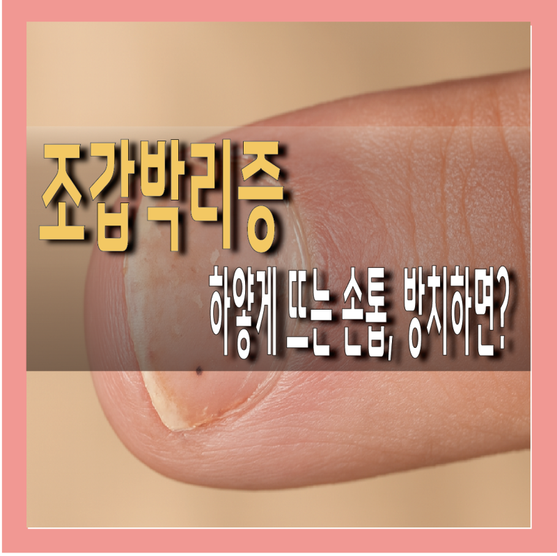 손톱 조갑박리증 원인, 연고 사용법, 병원 치료 방법 총정리
