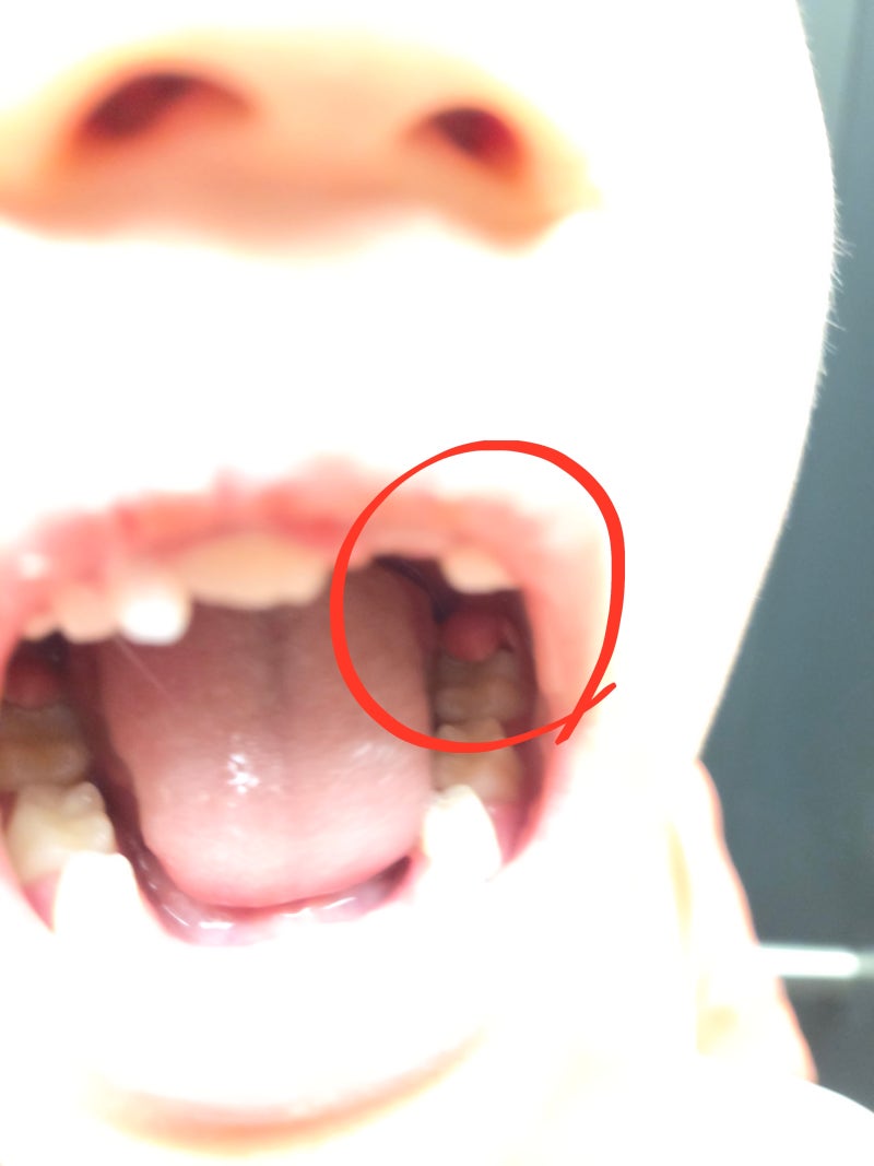 6~7세에 많이 발생하는 어린이 잇몸 염증, 잇몸 부음, 잇몸 고름은 맹출성 치은염일 수 있다네....