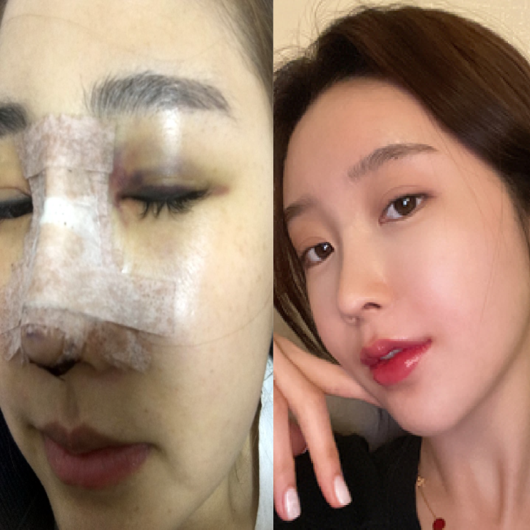  코수술 붓기차 말고 이게 직빵
