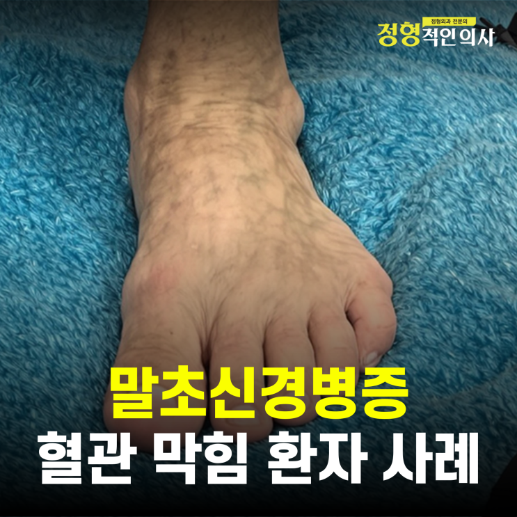  발이 저리고 시리고 화끈거리는 말초신경병증, 혈관이 막혀있던 환자의 치료 사례(의사작성)