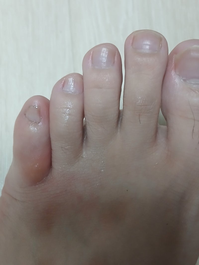 지네한테 발가락 물림 ㅠㅠ (약혐)