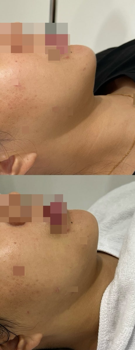  부산 서면 피부관리 v라인 리프팅 관리 서면 에스테틱 : 유리뷰티