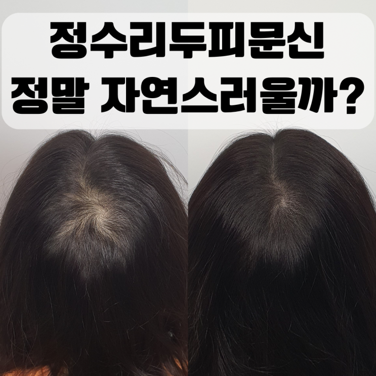  부산SMP두피문신으로 정수리 탈모 커버 가능할까? 실제 후기와 시술 꿀팁 공개!