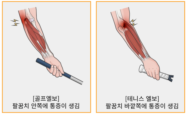테니스엘보 치료방법 후기, 집에서 꾸준히 관리한 경험담