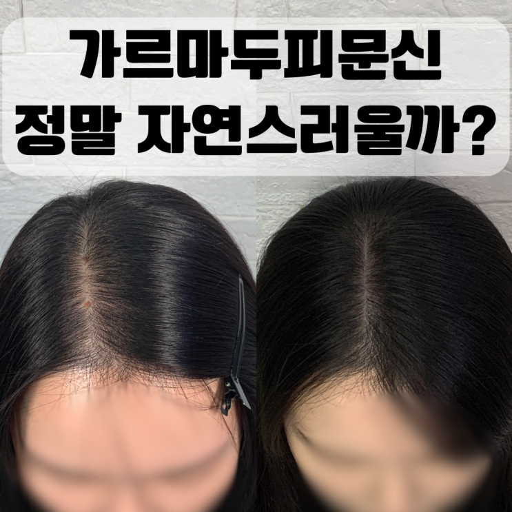  부산SMP두피문신, 가르마탈모 효과 있을까? 실제 후기와 시술 꿀팁까지 알려드릴게요!