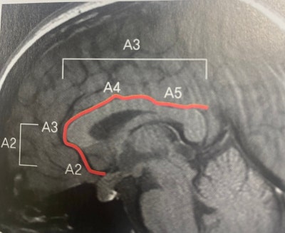 뇌혈관 해부학(Neurovascular Anatomy),뇌혈관구조와 Segment 쉽게 이해하기 : 네이버 블로그