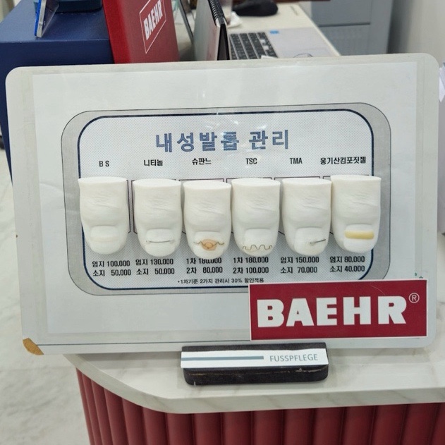  용인 처인구 제로푸스에서 발톱교정 받고 내성발톱 고민해결한 찐후기