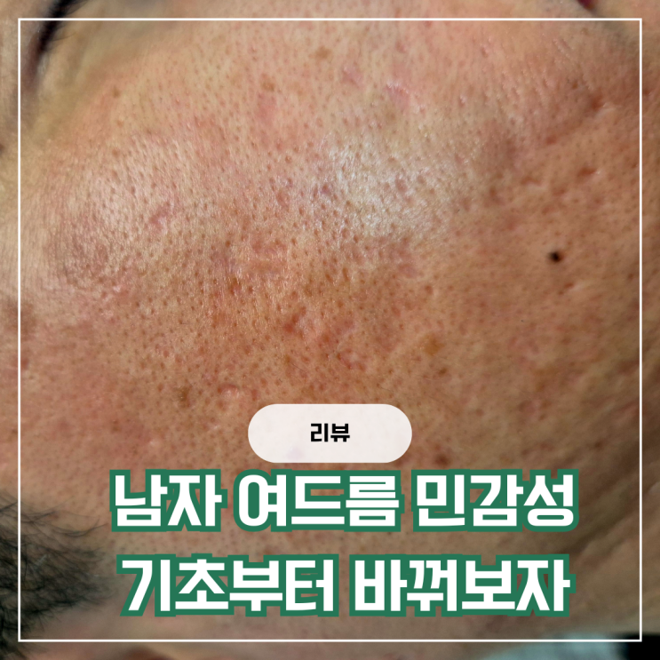 남자 여드름 민감성 지성 피부 깔끔하게 관리하는 기초 화장품