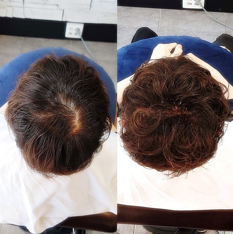  수원바버샵 20대 남성 링거펌, 정수리 모류 교정으로 탈모처럼 보이는 가르마 해결