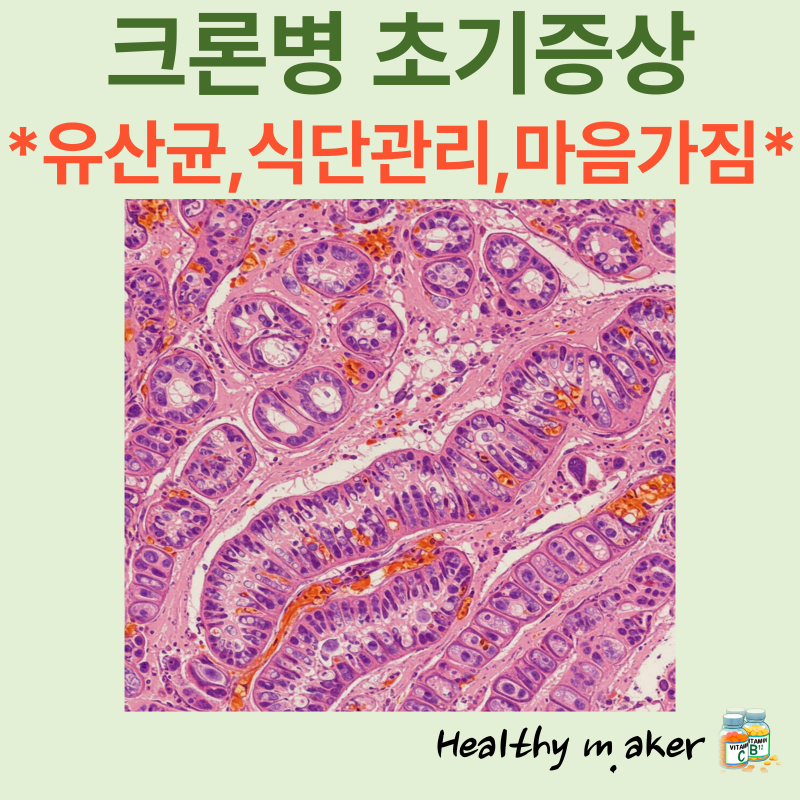 크론병 초기증상 극복: 유산균, 식단 관리, 그리고 긍정적인 마음가짐