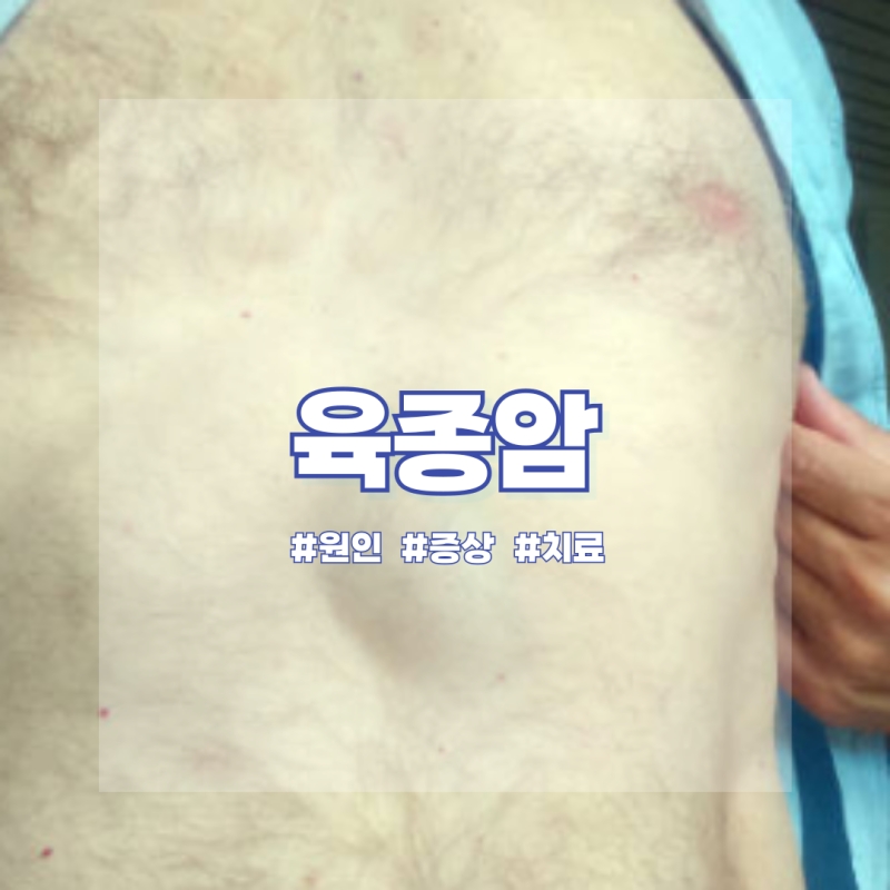 육종암, 희귀하지만 알아야 할 중요한 암 정보