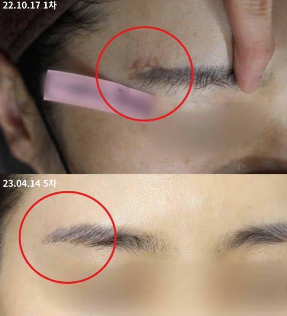  부산 흉터제거, 효과와 한계까지 솔직히 공개합니다