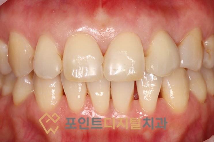  [탕정치과]  앞니 벌어짐 레진 재치료 / 천안 아산