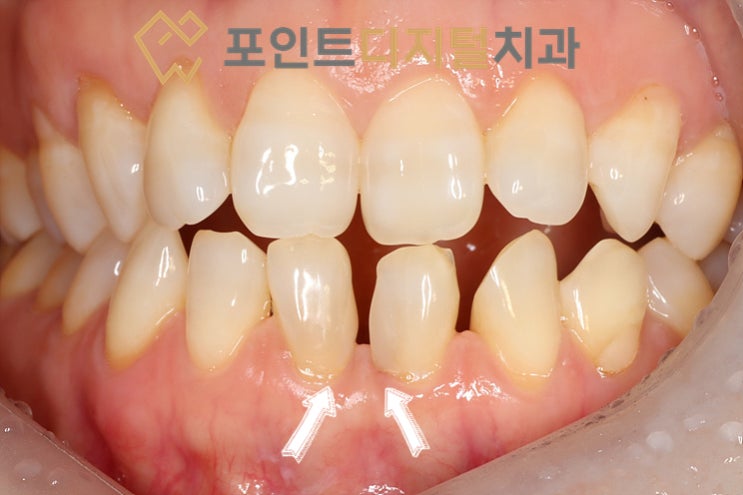  [탕정치과]  전문가 치아 미백 + 앞니 벌어짐 레진 재치료 / 천안 아산