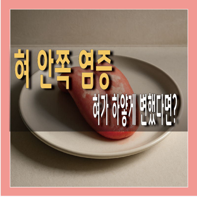 혀 안쪽 염증과 하얀 설염 증상 병원 어디로 가야 할까