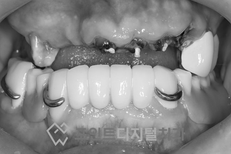  [탕정치과]  명절 선물(발치즉시 임플란트, 오스템) / 천안 아산