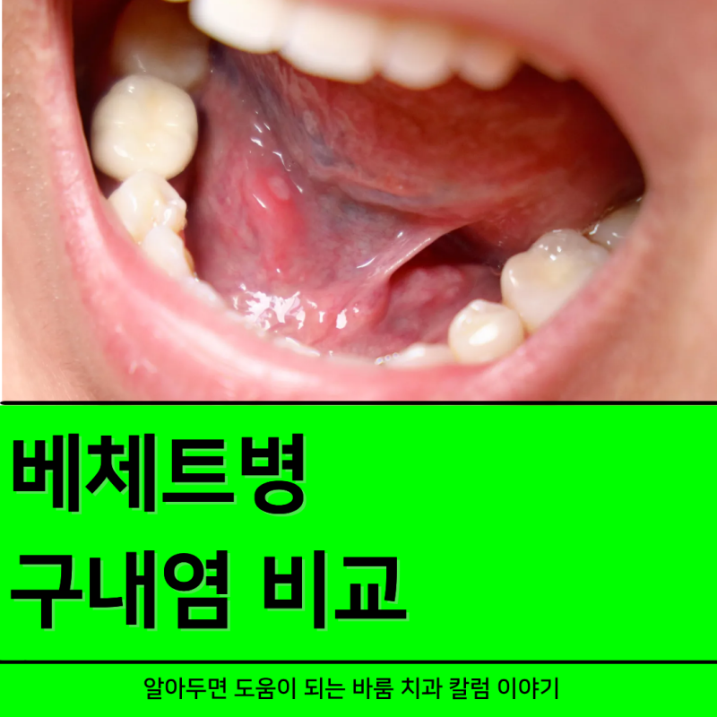 베체트병 구내염 전염 궁금한 이야기