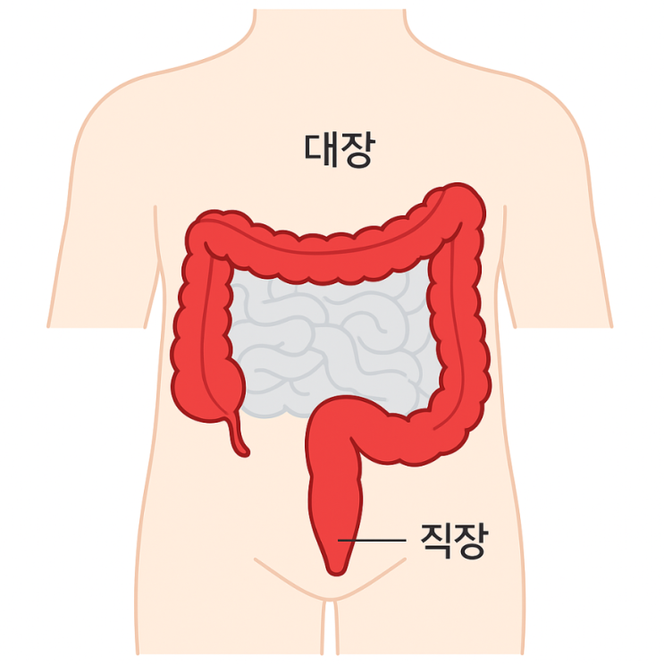  대장암 초기증상부터 예방법까지 알아보기