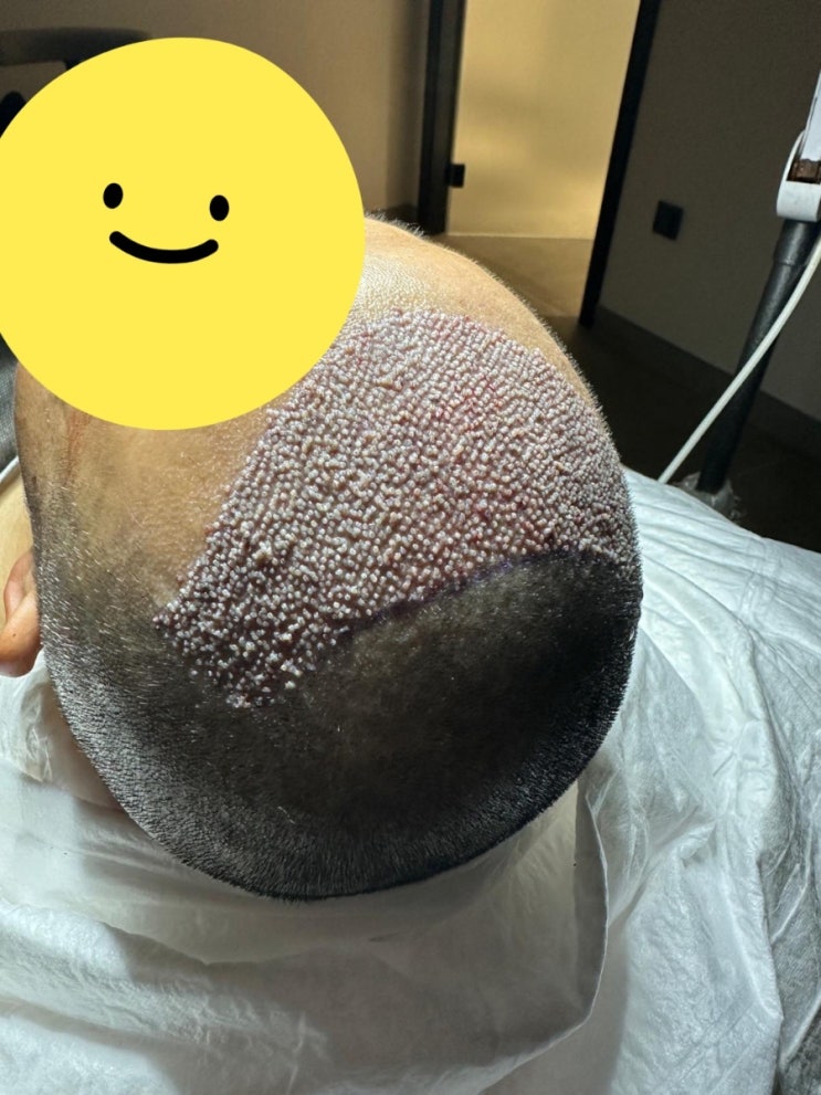  터키 모발이식 6000모 6개월차 후기 (대신 올려요) 