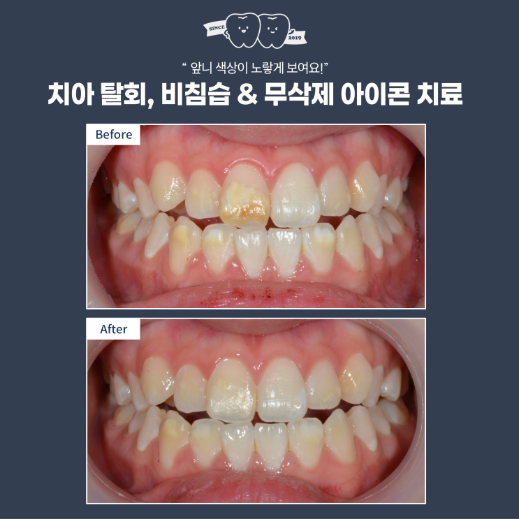  치아의 하얀 반점, 아이콘(Icon) 치료로 감쪽같이 없애기! 어디까지 효과 있을까?