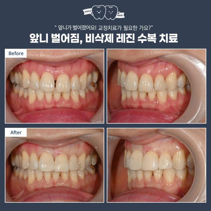  앞니 사이 공간, 앞니 벌어진 건 교정치료밖에 치료가 안 되나요? diastema 레진 수복 치료