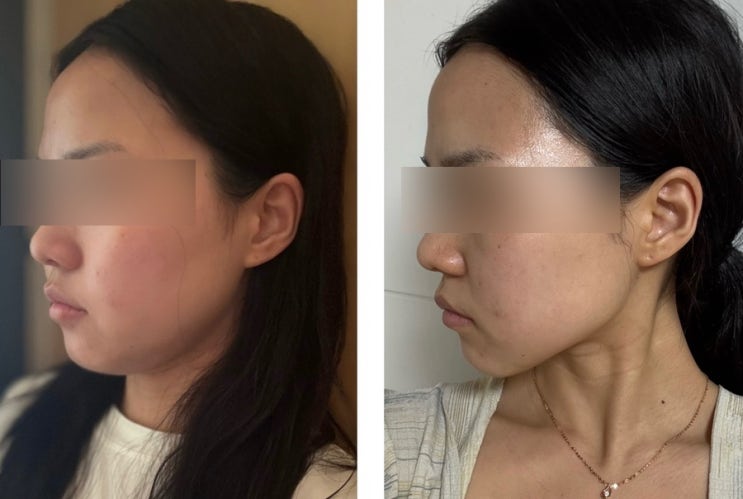  웨딩윤곽관리로 대구 울쎄라 알아보다가 선택한 올타이트리프팅 600 샷 후기 다운타임X